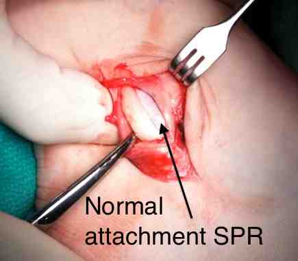 Anterior stripping of SPR
